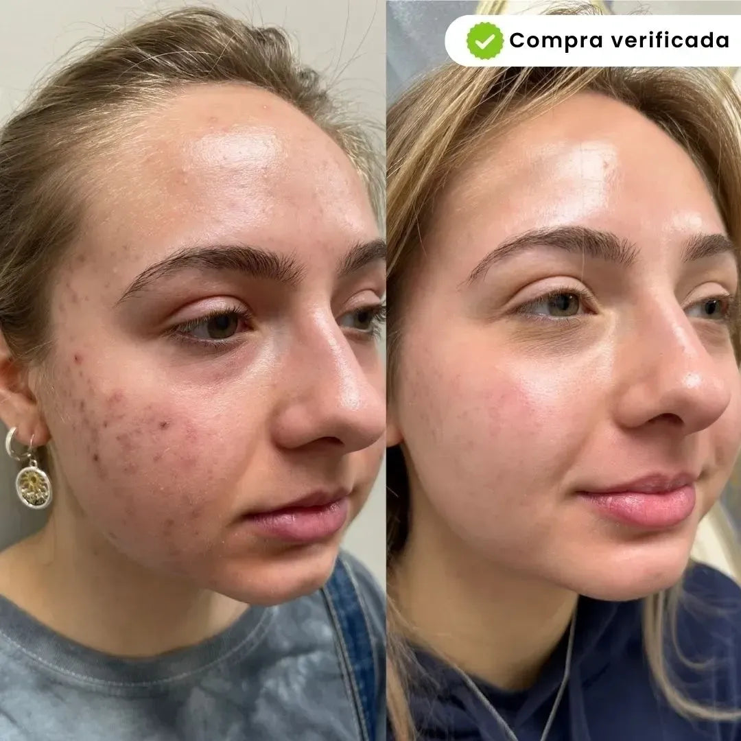 KIT BIOAQUA PARA ACNE - SKIN CARE🧴