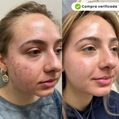 KIT BIOAQUA PARA ACNE - SKIN CARE🧴